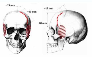 Autopsia de cráneo de Rustem Slobodín
